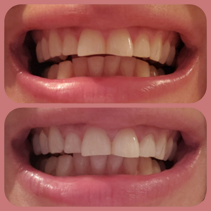 Activated Charcoal Teeth Whitening